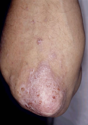 Gocce per unghie da psoriasi di unghie