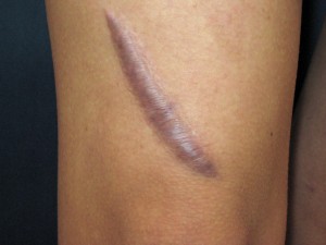 CO2 Laser Works Best for Hypertrophic Scars | EDIZIONI ...