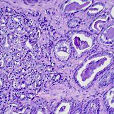 tumore prostata con metastasi ossee diffuse tumore prostata con metastasi ossee diffuse